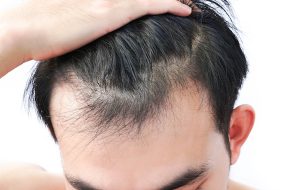 Tips On Getting A Best Hair Loss Shampoo