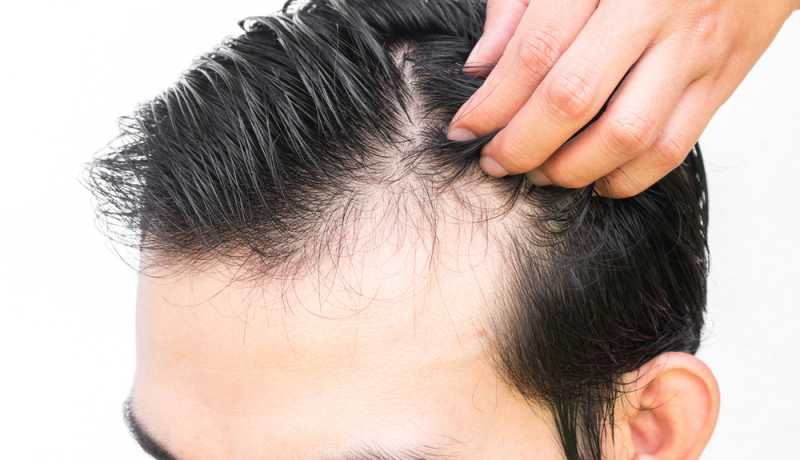 Hair loss concealers are trending for treating hair problems