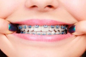 Smile with confidence: Benefits of braces
