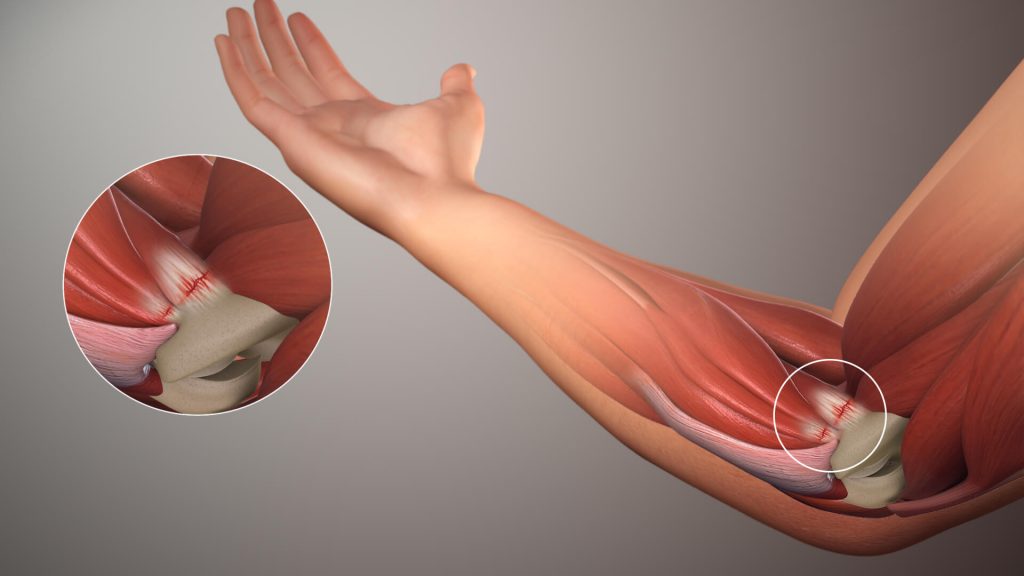 golfers elbow treatment