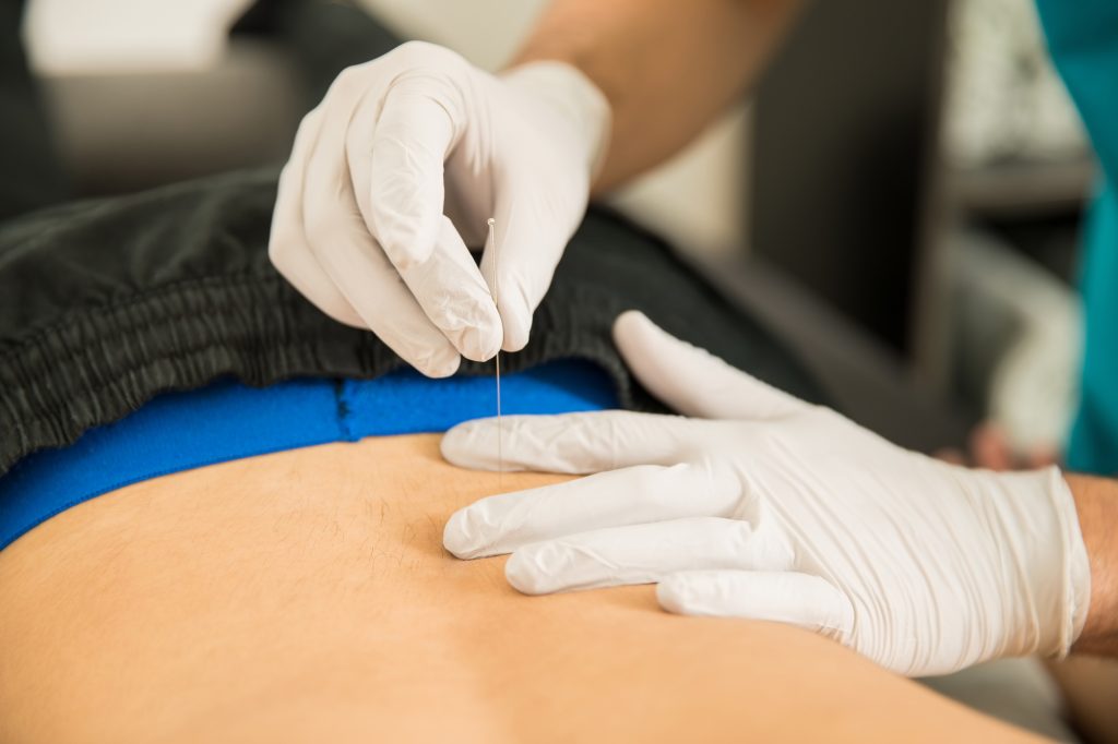 Physiotherapist Doing Dry Puncture On Back Of Male Patient