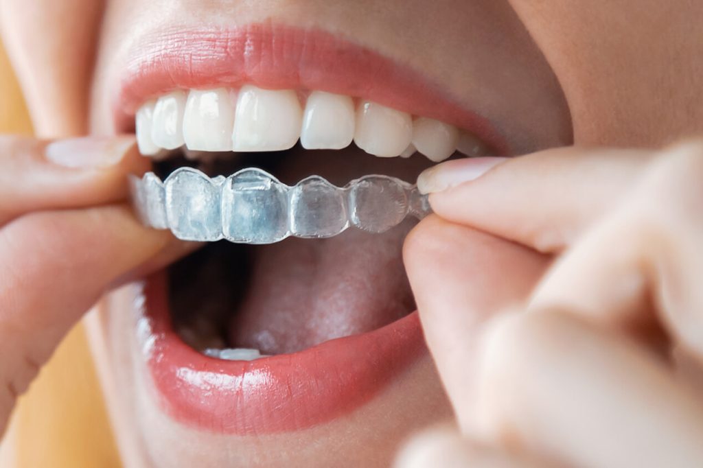 Clear Aligners