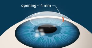 Tips for a Successful Smile Eye Surgery Procedure