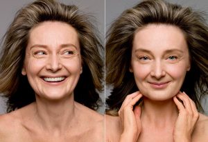 Treatments those are available to get rid of sagging issues